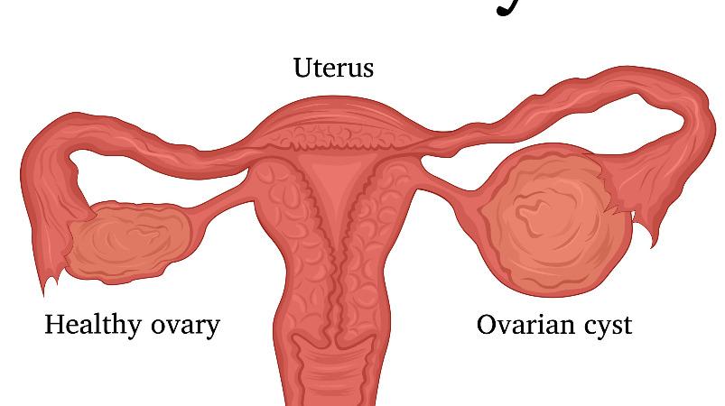 can-menstrual-cysts-solve-women-s-problems