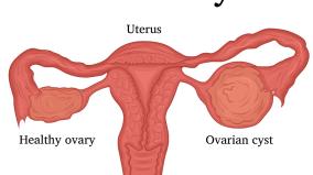 can-menstrual-cysts-solve-women-s-problems
