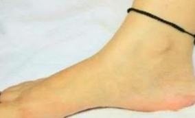 left-leg-karuppu-kayiru-remedy