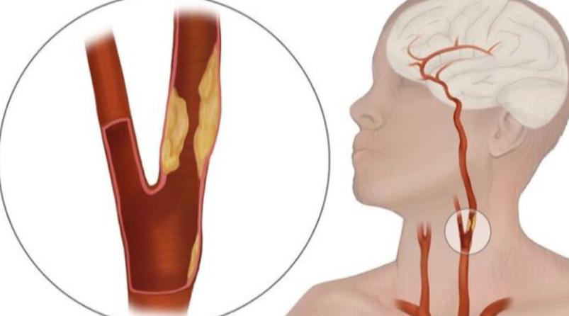 actor-vivek-heart-attack-health-tips