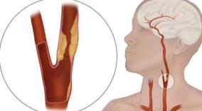 actor-vivek-heart-attack-health-tips