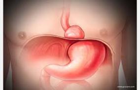 hernia-kudalirakkam-health-tips