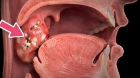 tonsillitis-health-tips