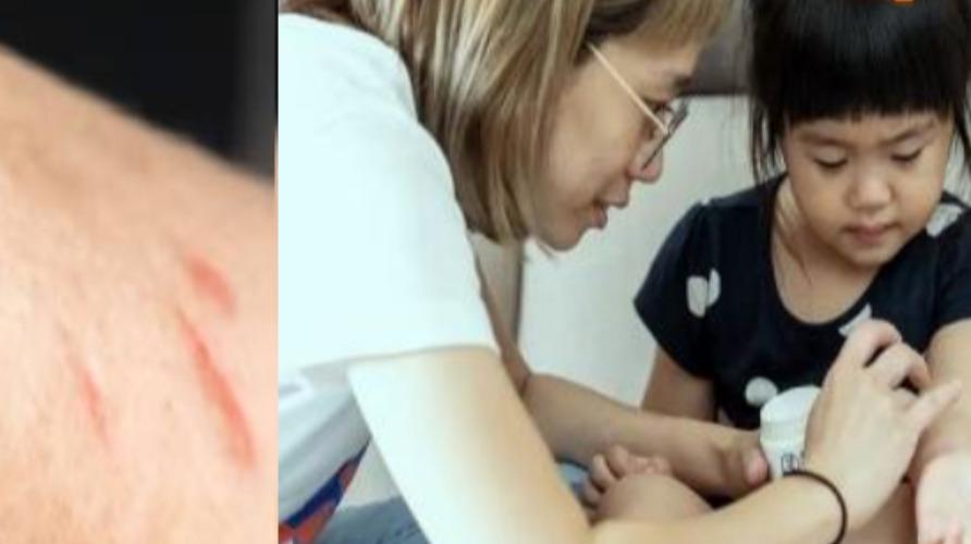 fire-accident-skin-infection-health-tips