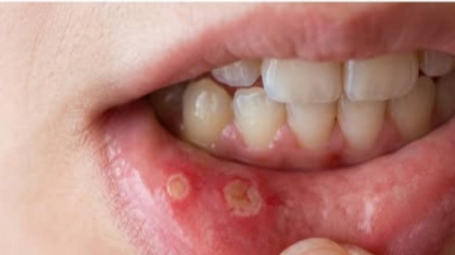 mouth-ulcer-health-tips